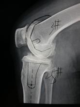 退行性变 退行性变