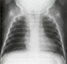 法洛氏四联症1月女孩 法洛氏四联症1月女孩