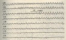 继发性癫痫 继发性癫痫